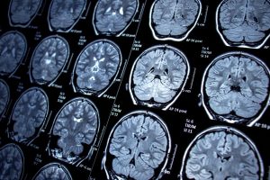Vasario 10-oji Europos epilepsijos diena: bijoti nereikia suprasti. Kur dėsime kablelį?